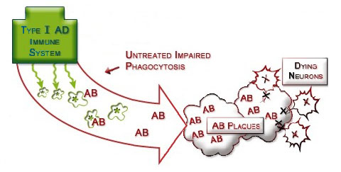 Fig iii.4 Impaired Immune System in Alzheimer's disease