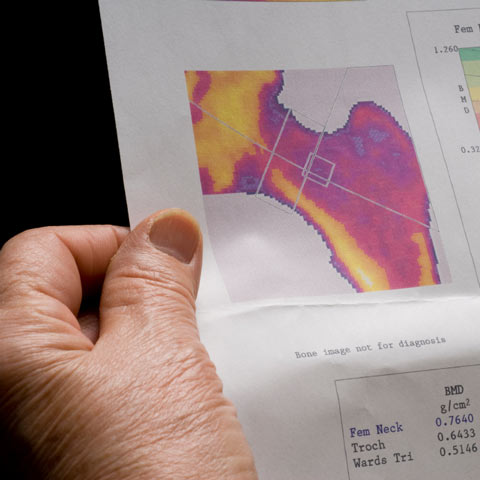 Alpha lipoic acid can reduce bone lose in patients with osteoporosis.