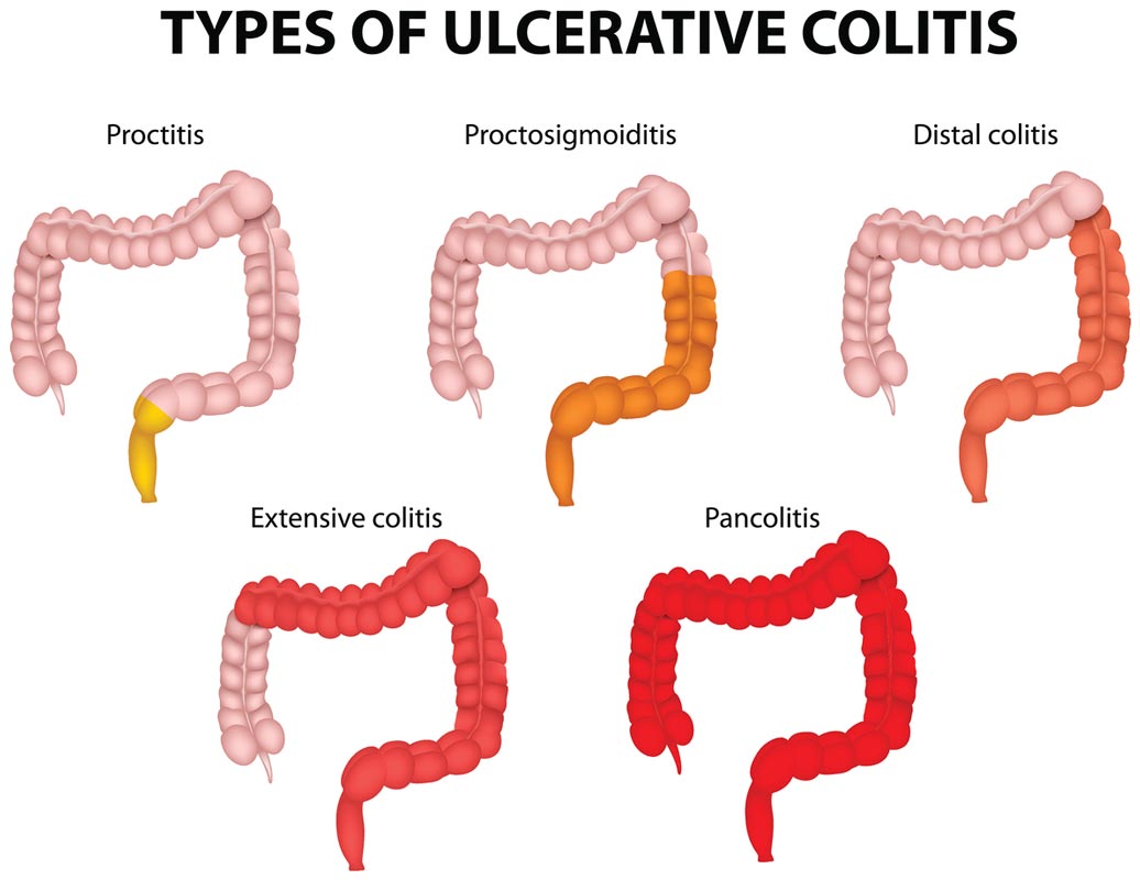 Anti-inflammatory antioxidants such as alpha lipoic acid could help treat ulcerative colitis.