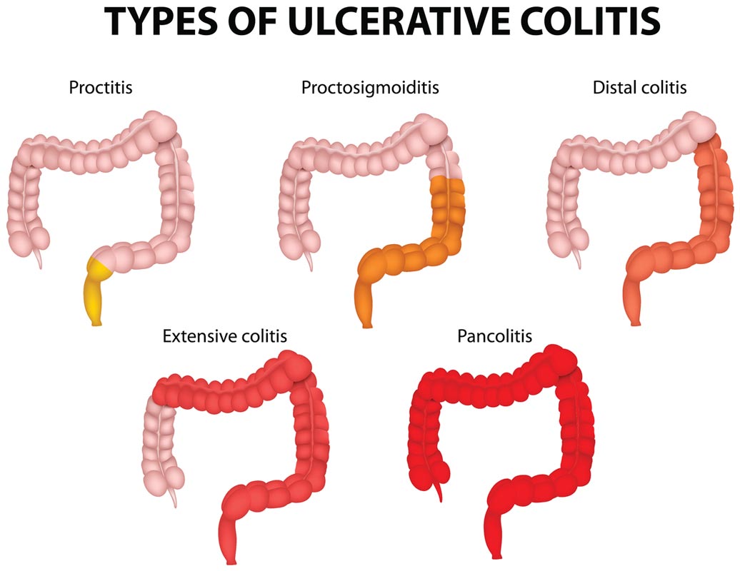 Ulcerative colitis is a form of IBD. Anti-inflammatory antioxidants such as alpha lipoic acid could help treat ulcerative colitis.