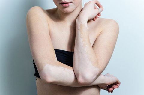Vitiligo is a condition with areas of skin hypopigmentation.
