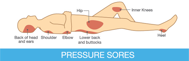 Pressure sores are chronic wounds that are slow to heal. Antioxidants such as alpha lipoic acid can help hasten healing.