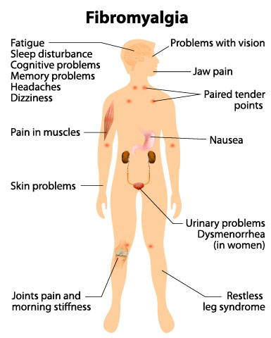 Symptoms of fibromyalgia. Antioxidants such as alpha lipoic acid may help relieve fibromyalgia symptoms.