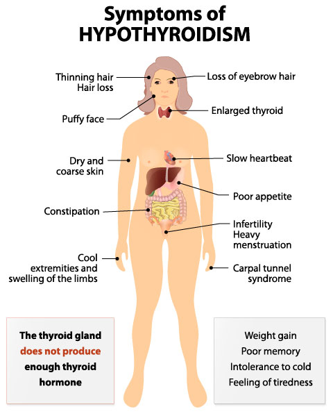Hypothyroidism is when the thyroid gland doesn't produce enought thyroid hormone. Symptoms include thinning hair, dry skin, and weight gain.