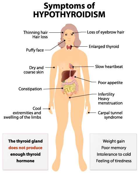 What are the signs and symptoms of hypothyroidism? Hypothyroidism is when the thyroid gland doesn't produce enought thyroid hormone. Symptoms include thinning hair, dry skin, and weight gain.