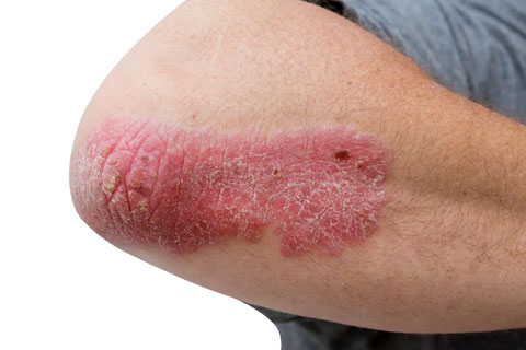 Help Treat Psoriasis Anti-inflammatory antioxidants can help treat inflammatory skin rashes like psoriasis and dermatitis.
